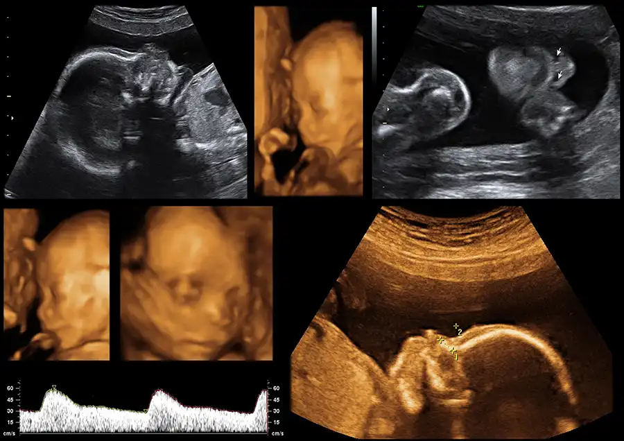 diagnostica prenatale padova policlinico abano