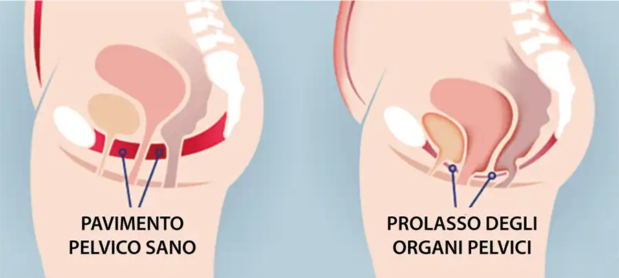 uroginecologia padova policlinico abano terme