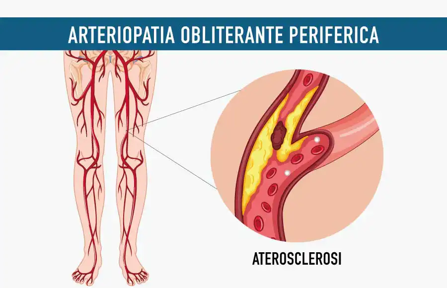 arteriopatia obliterante periferica policlinico abano terme