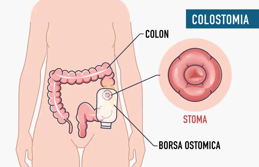 stomizzati padova policlinico abano terme