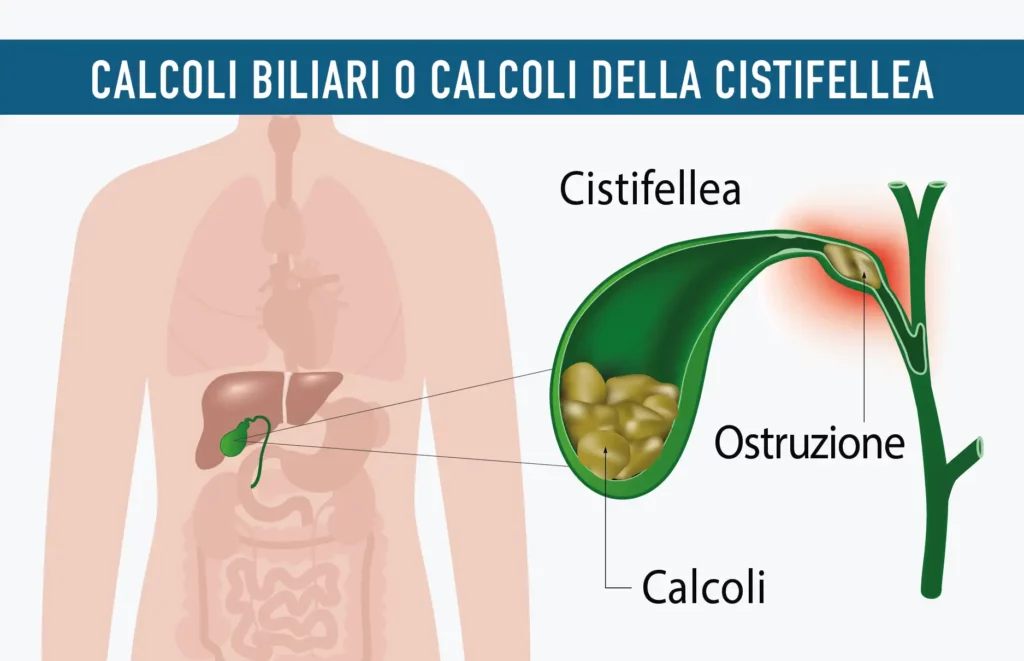 Calcoli biliari cistifellea Policlinico Abano Terme Padova