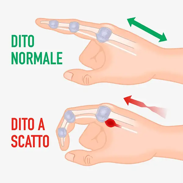 Dito a scatto Policlinico Abano Terme